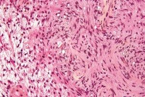 Schwannoma_-_Antoni_A_and_B_-_very_high_mag-300x200